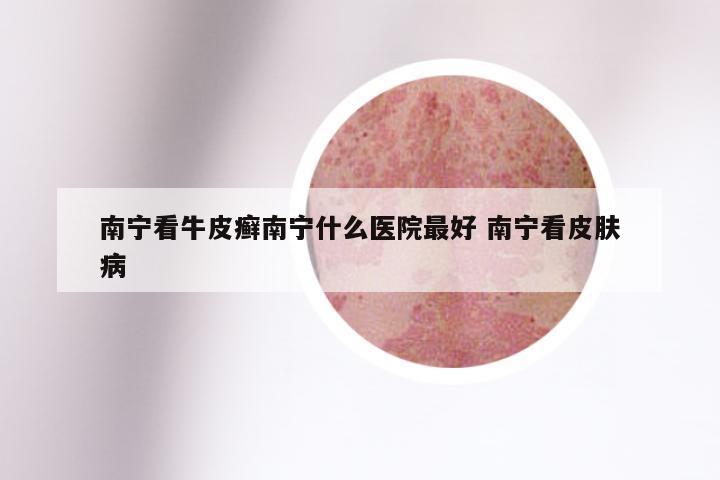 南宁看牛皮癣南宁什么医院最好 南宁看皮肤病