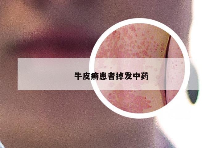 牛皮癣患者掉发中药