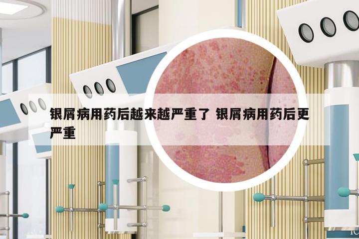 银屑病用药后越来越严重了 银屑病用药后更严重