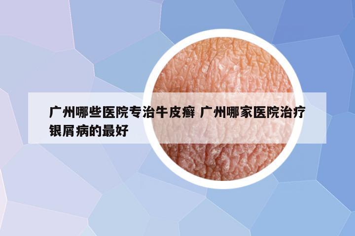 广州哪些医院专治牛皮癣 广州哪家医院治疗银屑病的最好
