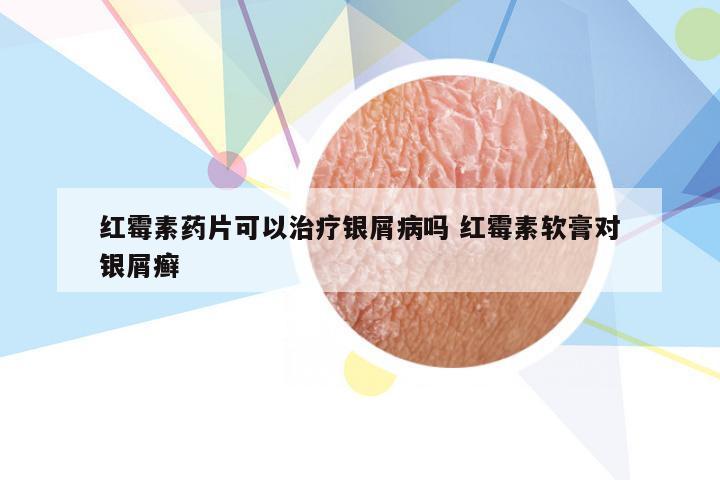 红霉素药片可以治疗银屑病吗 红霉素软膏对银屑癣