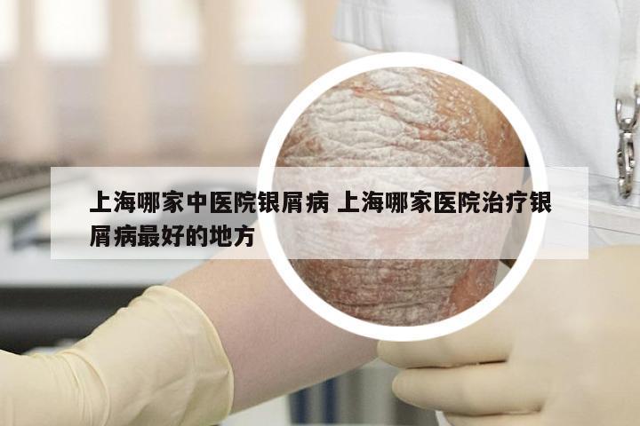 上海哪家中医院银屑病 上海哪家医院治疗银屑病最好的地方