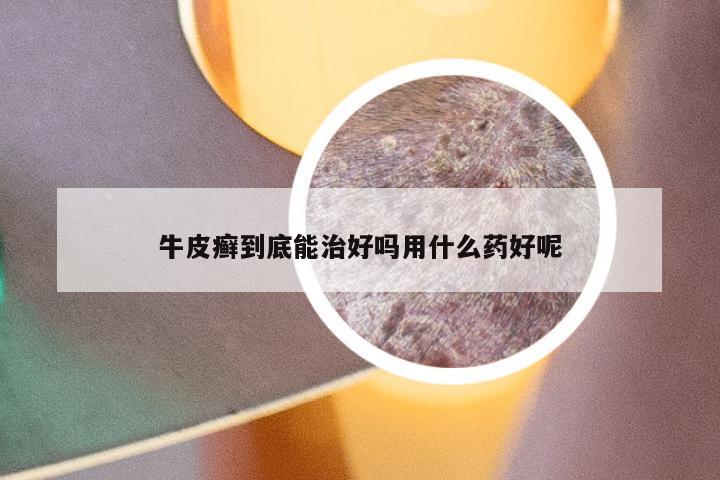 牛皮癣到底能治好吗用什么药好呢