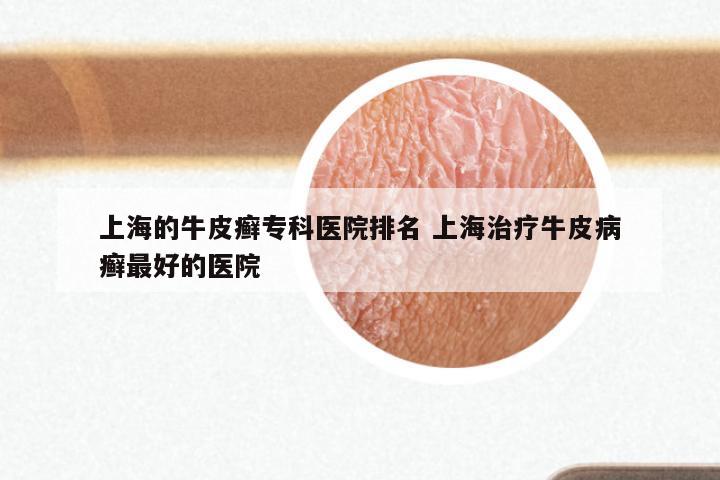 上海的牛皮癣专科医院排名 上海治疗牛皮病癣最好的医院