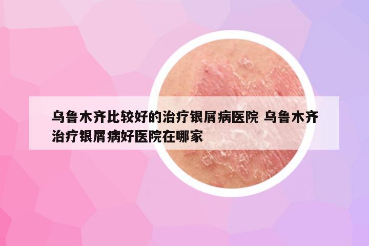 乌鲁木齐比较好的治疗银屑病医院 乌鲁木齐治疗银屑病好医院在哪家