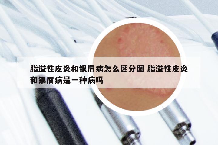 脂溢性皮炎和银屑病怎么区分图 脂溢性皮炎和银屑病是一种病吗