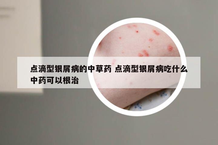 点滴型银屑病的中草药 点滴型银屑病吃什么中药可以根治