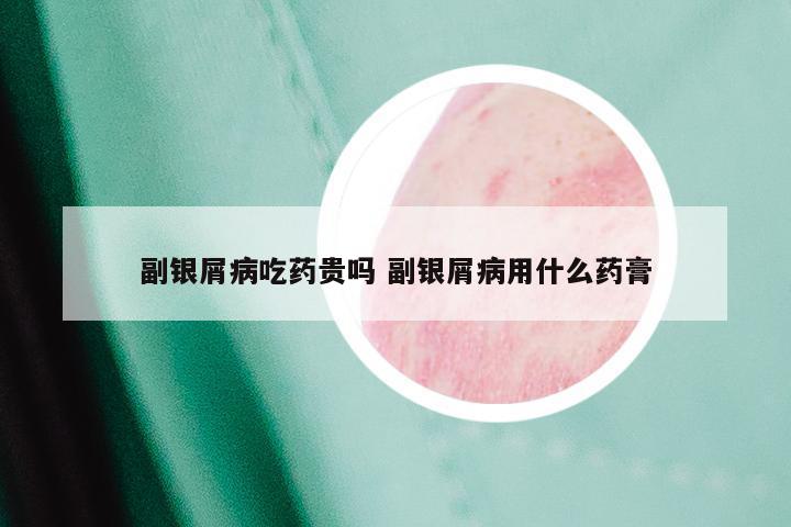 副银屑病吃药贵吗 副银屑病用什么药膏