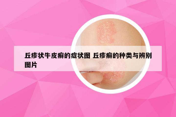 丘疹状牛皮癣的症状图 丘疹癣的种类与辨别图片