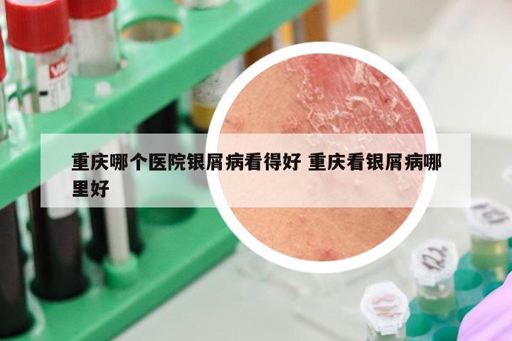 重庆哪个医院银屑病看得好 重庆看银屑病哪里好