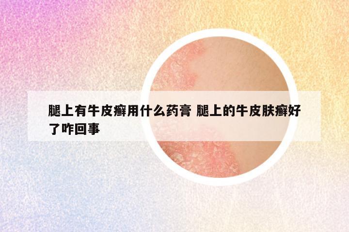 腿上有牛皮癣用什么药膏 腿上的牛皮肤癣好了咋回事