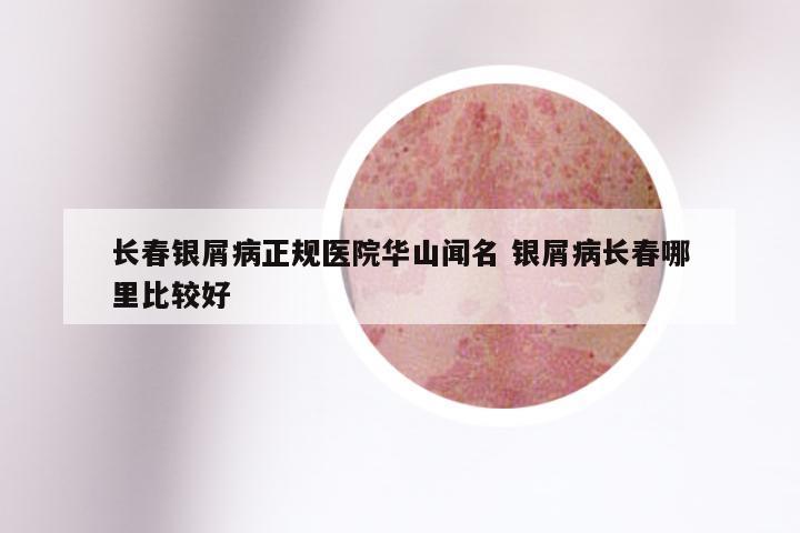 长春银屑病正规医院华山闻名 银屑病长春哪里比较好