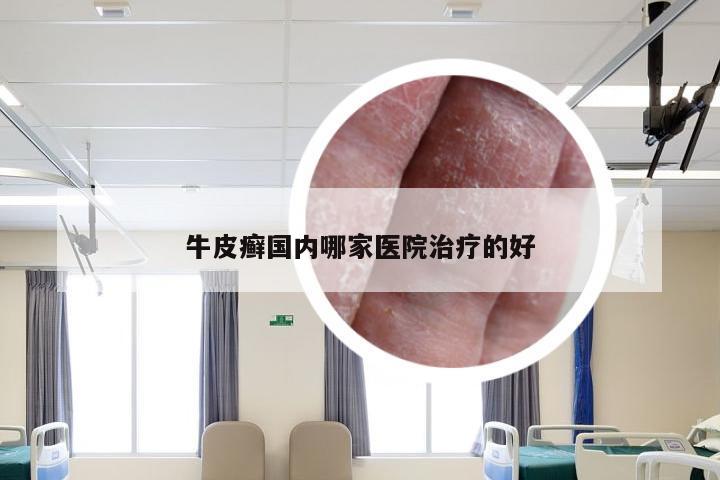 牛皮癣国内哪家医院治疗的好