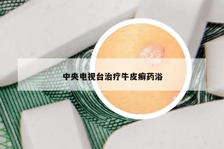 中央电视台治疗牛皮癣药浴