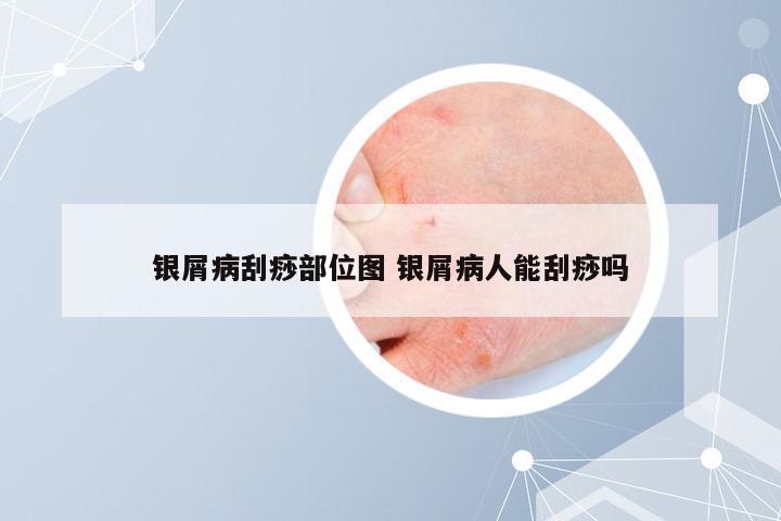 银屑病刮痧部位图 银屑病人能刮痧吗