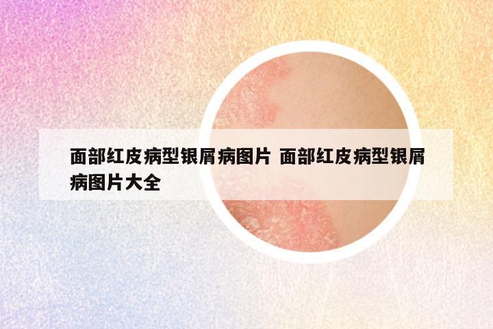 面部红皮病型银屑病图片 面部红皮病型银屑病图片大全