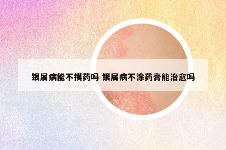 银屑病能不摸药吗 银屑病不涂药膏能治愈吗