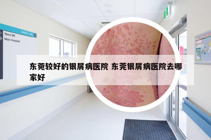 东菀较好的银屑病医院 东莞银屑病医院去哪家好