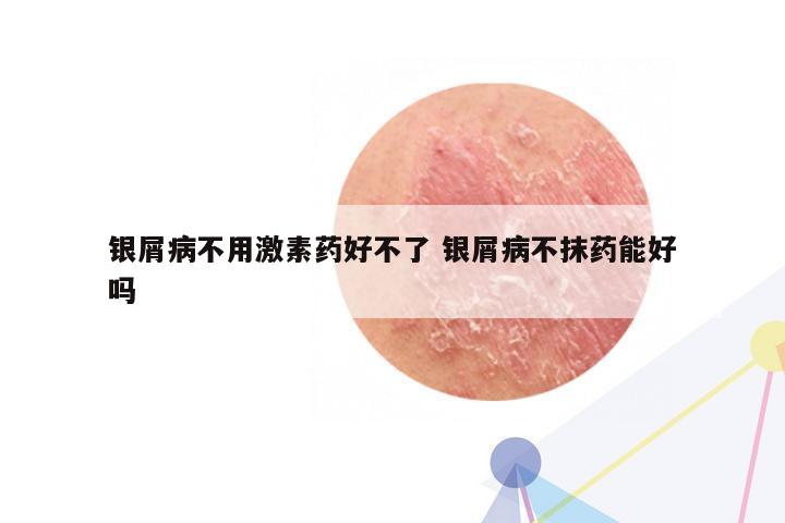 银屑病不用激素药好不了 银屑病不抹药能好吗