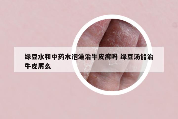绿豆水和中药水泡澡治牛皮癣吗 绿豆汤能治牛皮屑么