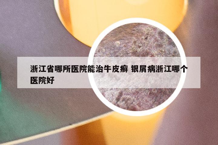 浙江省哪所医院能治牛皮癣 银屑病浙江哪个医院好