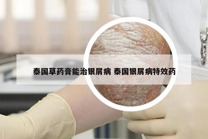泰国草药膏能治银屑病 泰国银屑病特效药