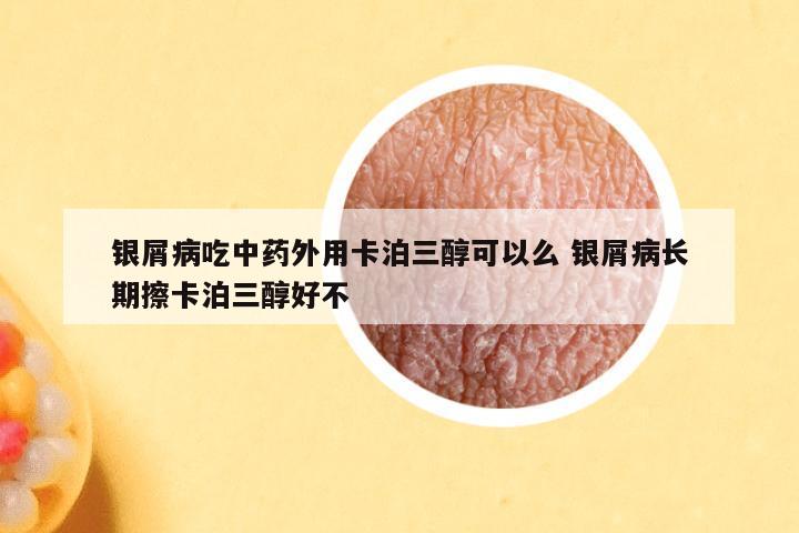 银屑病吃中药外用卡泊三醇可以么 银屑病长期擦卡泊三醇好不