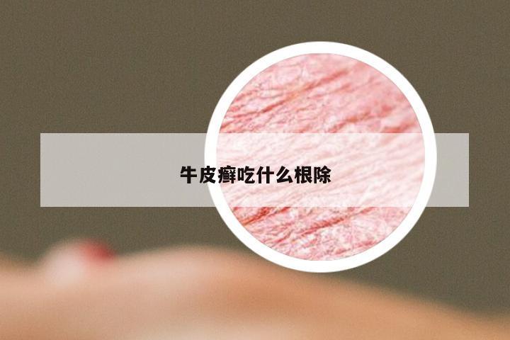 牛皮癣吃什么根除