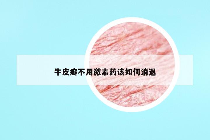 牛皮癣不用激素药该如何消退