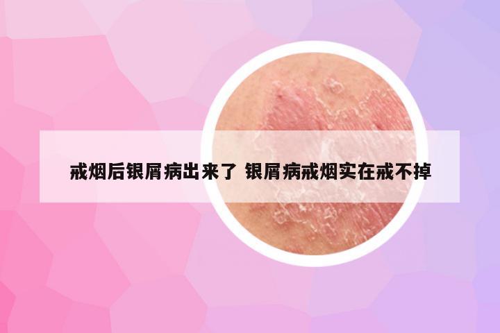 戒烟后银屑病出来了 银屑病戒烟实在戒不掉