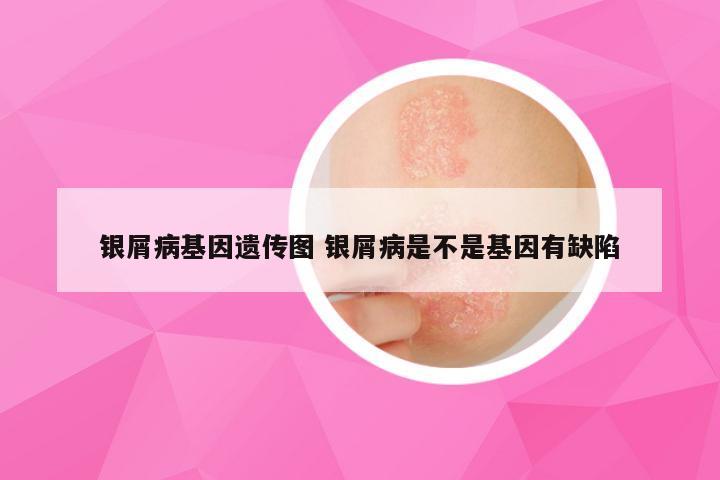 银屑病基因遗传图 银屑病是不是基因有缺陷