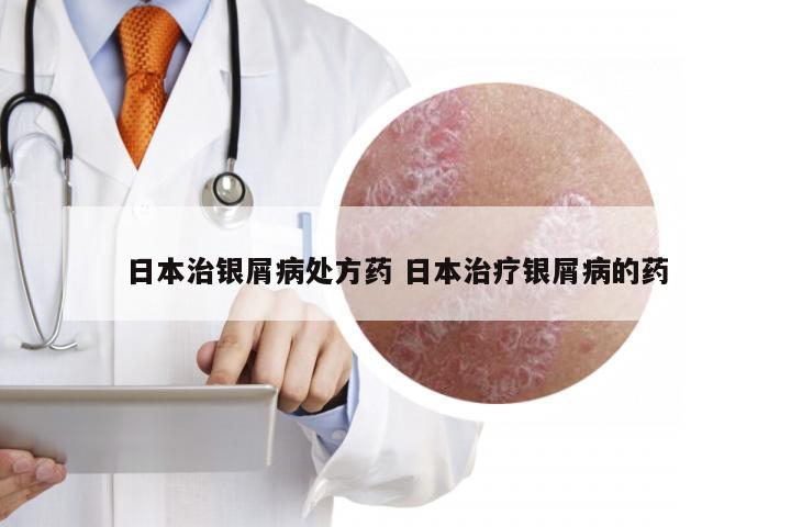 日本治银屑病处方药 日本治疗银屑病的药