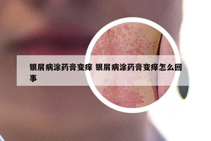 银屑病涂药膏变痒 银屑病涂药膏变痒怎么回事