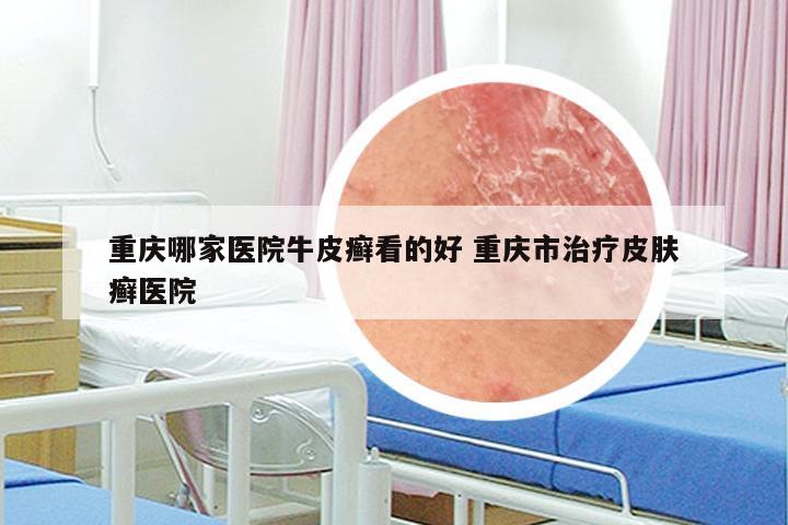 重庆哪家医院牛皮癣看的好 重庆市治疗皮肤癣医院