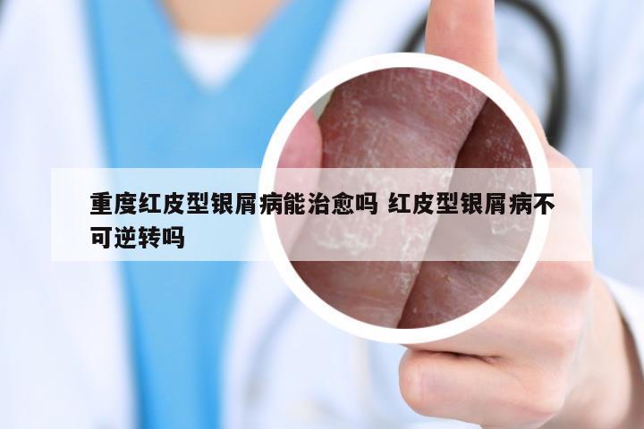 重度红皮型银屑病能治愈吗 红皮型银屑病不可逆转吗