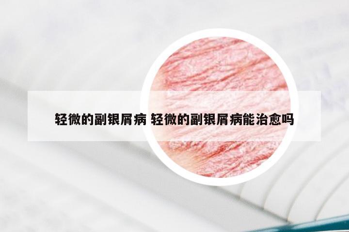 轻微的副银屑病 轻微的副银屑病能治愈吗