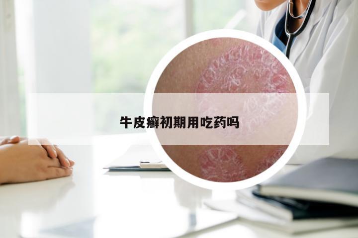 牛皮癣初期用吃药吗