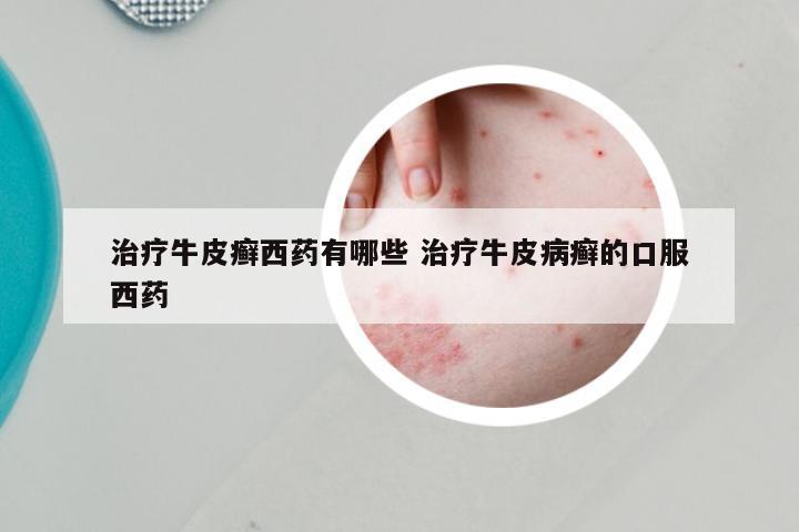 治疗牛皮癣西药有哪些 治疗牛皮病癣的口服西药