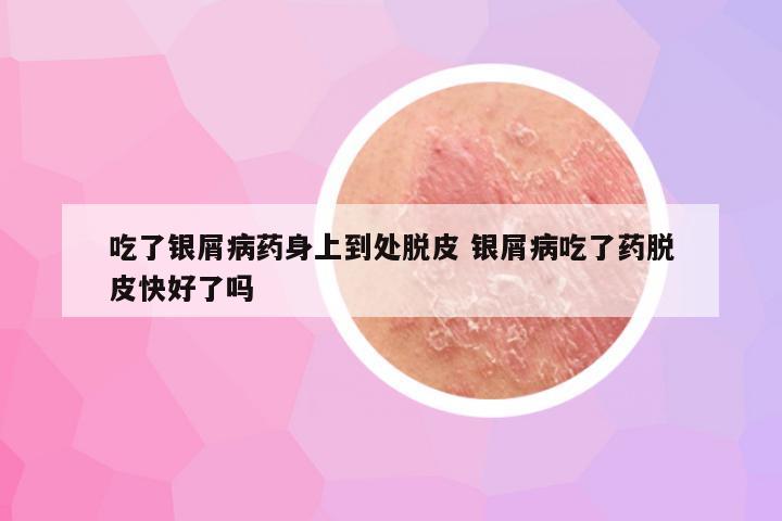 吃了银屑病药身上到处脱皮 银屑病吃了药脱皮快好了吗