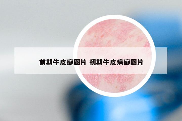 前期牛皮癣图片 初期牛皮病癣图片