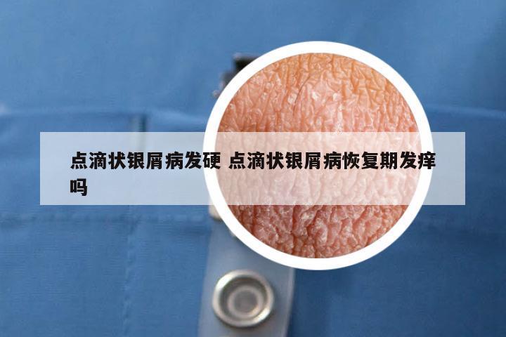 点滴状银屑病发硬 点滴状银屑病恢复期发痒吗