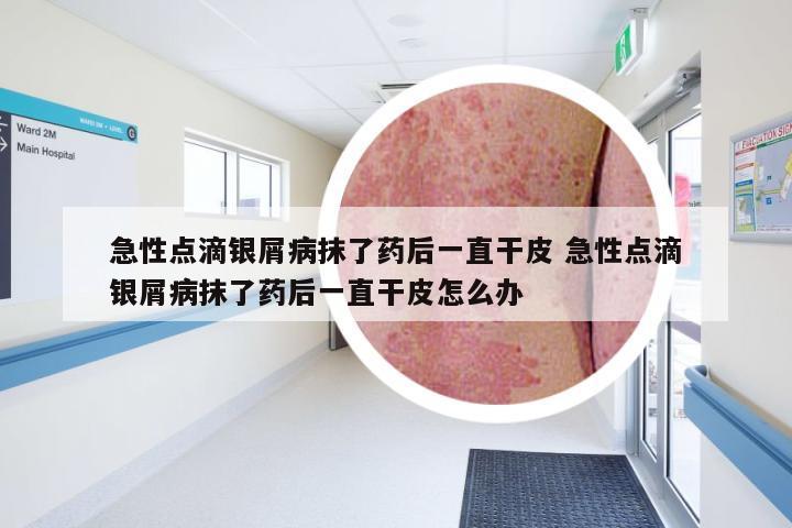 急性点滴银屑病抹了药后一直干皮 急性点滴银屑病抹了药后一直干皮怎么办