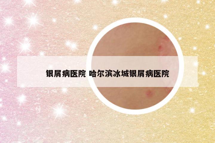 银屑病医院 哈尔滨冰城银屑病医院