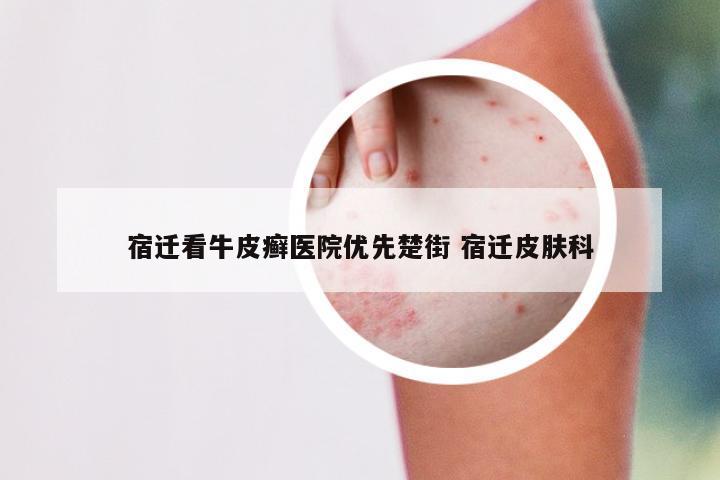 宿迁看牛皮癣医院优先楚街 宿迁皮肤科