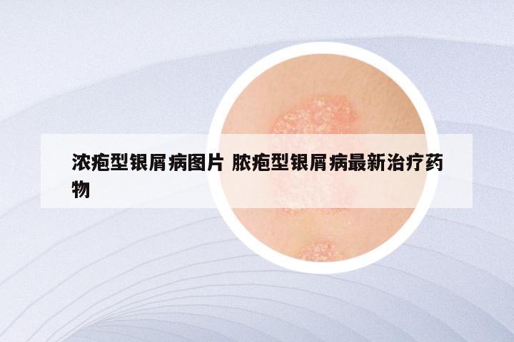 浓疱型银屑病图片 脓疱型银屑病最新治疗药物
