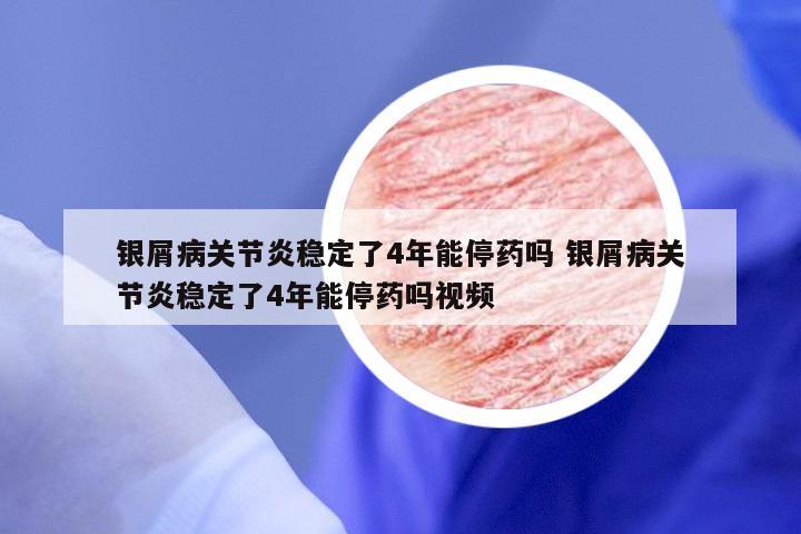 银屑病关节炎稳定了4年能停药吗 银屑病关节炎稳定了4年能停药吗视频