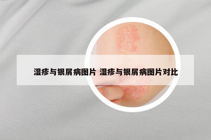湿疹与银屑病图片 湿疹与银屑病图片对比