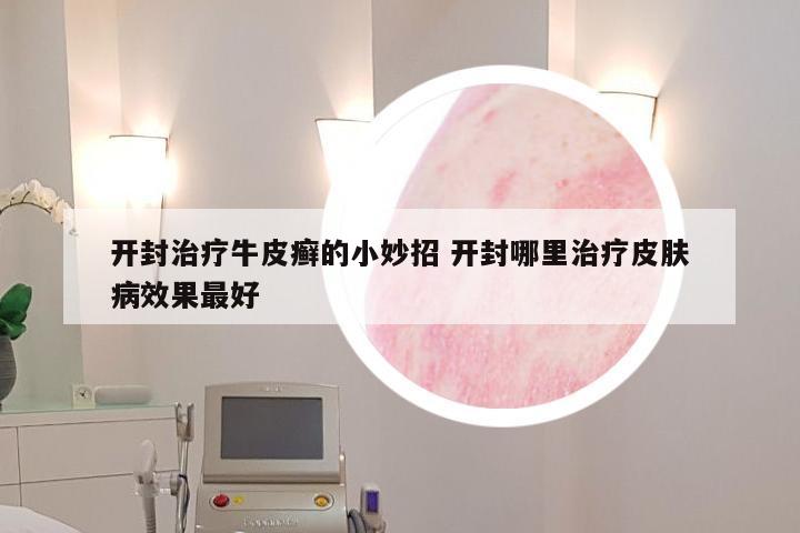 开封治疗牛皮癣的小妙招 开封哪里治疗皮肤病效果最好