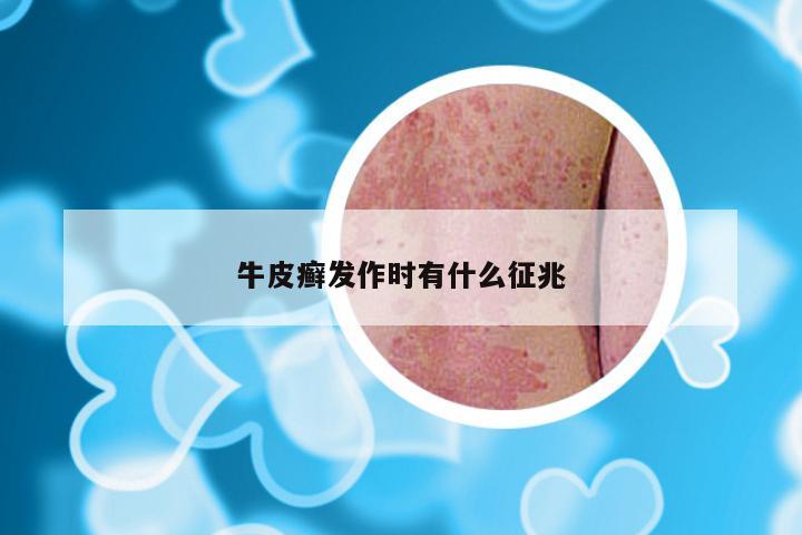 牛皮癣发作时有什么征兆