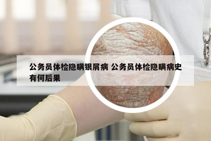 公务员体检隐瞒银屑病 公务员体检隐瞒病史有何后果